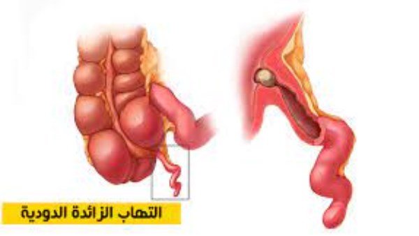 راقب صحتك: علامات التهاب الزائدة الدودية قبل حدوث الانفجار