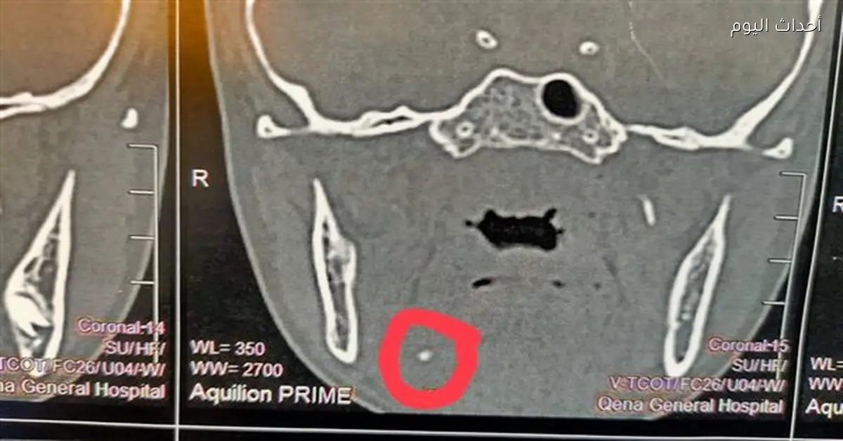 استئصال غدة لطفل 11 عامًا بنجاح في مستشفى قنا العام