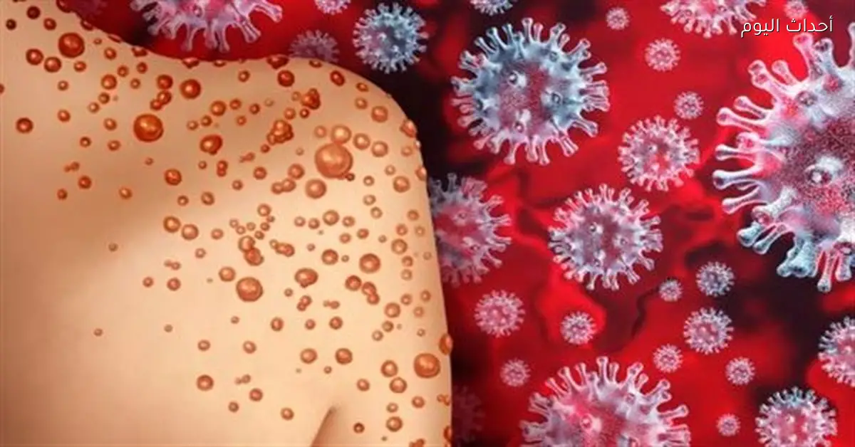 تفشي جدري القرود في الكاميرون والسلطات الصحية تتدخل بسرعة