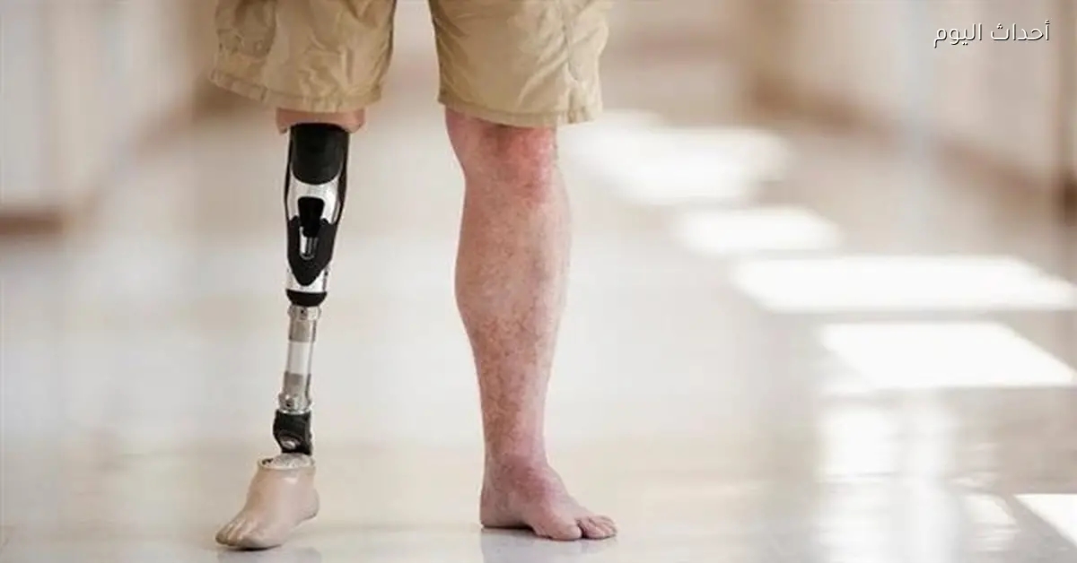 توطين صناعة الأطراف الصناعية يعزز العدالة الاجتماعية ويخفف الأعباء